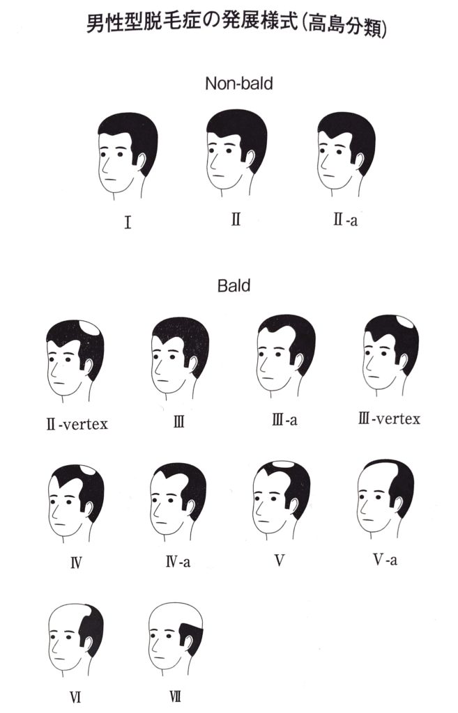 男性型脱毛症の高島分類表